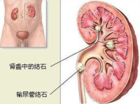肾结石的食疗方法,多款食谱助您排石养肾